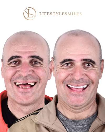 Lifestyle Smiles before and after