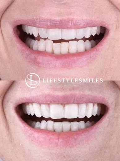 Lifestyle Smiles treatment creative